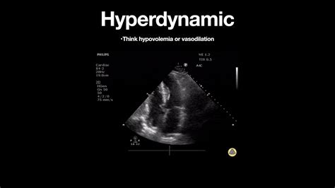 left ventricular function becomes hyperdynamic.